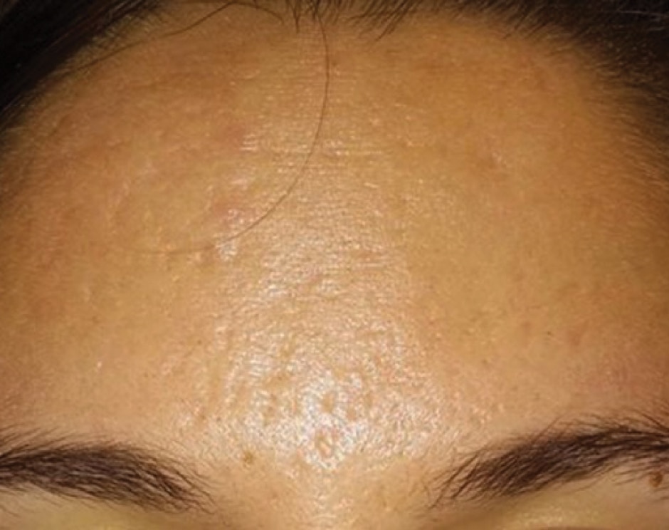 SkinPen After 1