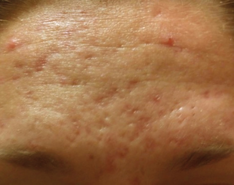 SkinPen Before 1