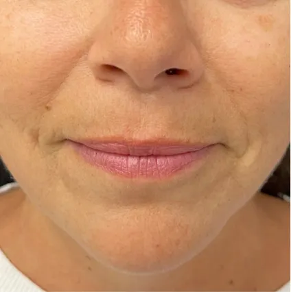 Face 6 Botox and Fillers | OrangeTwist Anti-Aging Treatments