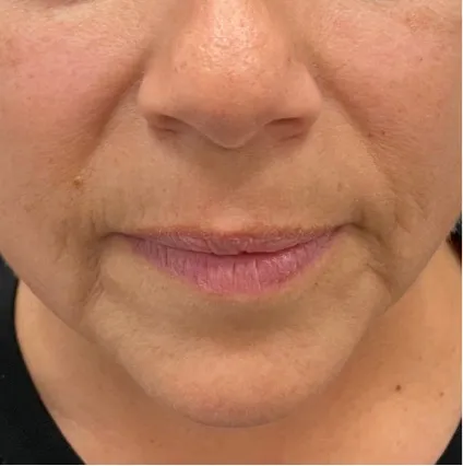 Face 5 Botox and Fillers | OrangeTwist Anti-Aging Treatments