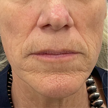 Face 4 Botox and Fillers | OrangeTwist Anti-Aging Treatments
