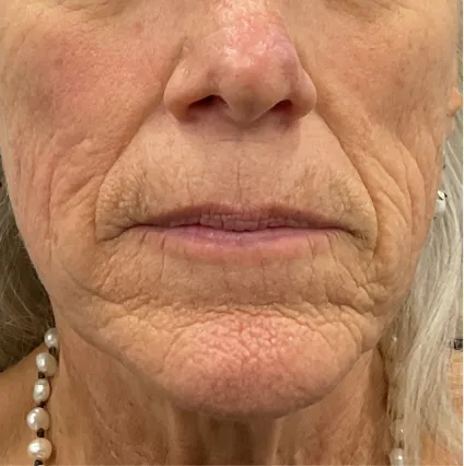 Face 3 after treatment Botox and Fillers | OrangeTwist Anti-Aging Treatments