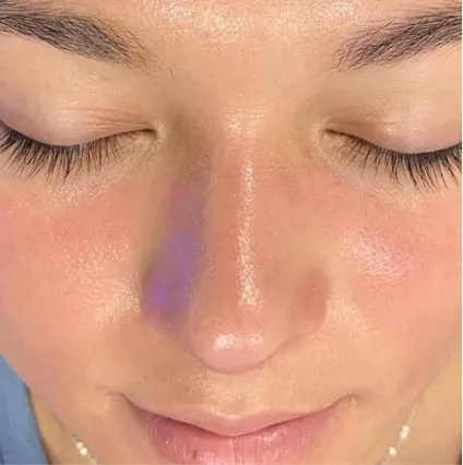 Nose After Treatment HydraFacial Med Spa Facials at OrangeTwist | Hydradermabrasion Peel