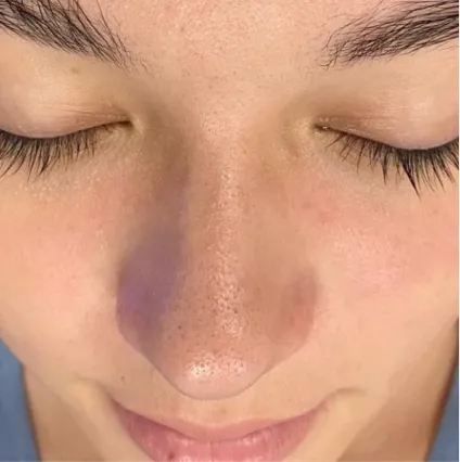 Nose HydraFacial Med Spa Facials at OrangeTwist | Hydradermabrasion Peel