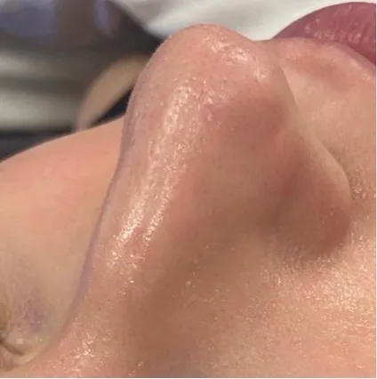 Nose After Treatment HydraFacial Med Spa Facials at OrangeTwist | Hydradermabrasion Peel