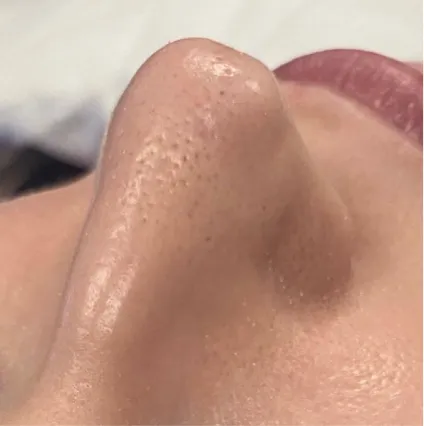 Nose After Treatment HydraFacial Med Spa Facials at OrangeTwist | Hydradermabrasion Peel