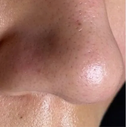 Nose HydraFacial Med Spa Facials at OrangeTwist | Hydradermabrasion Peel