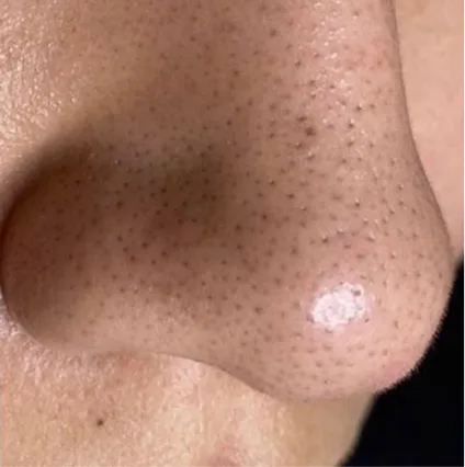 Nose Before Treatment HydraFacial Med Spa Facials at OrangeTwist | Hydradermabrasion Peel