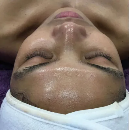 Woman After Treatment HydraFacial Med Spa Facials at OrangeTwist | Hydradermabrasion Peel