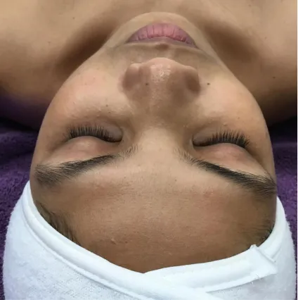 Woman HydraFacial Med Spa Facials at OrangeTwist | Hydradermabrasion Peel
