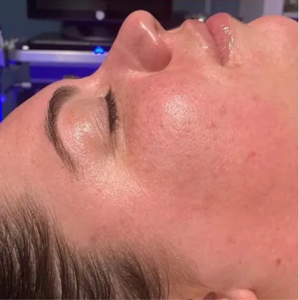 Woman After Treatment HydraFacial Med Spa Facials at OrangeTwist | Hydradermabrasion Peel