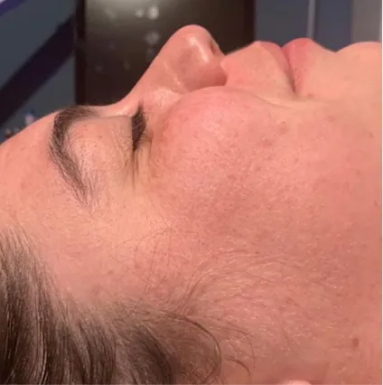 Woman HydraFacial Med Spa Facials at OrangeTwist | Hydradermabrasion Peel
