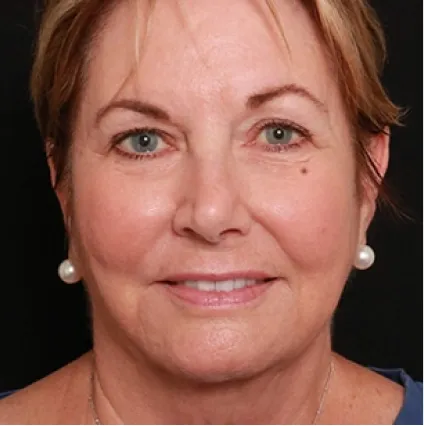 Face after Treatment Skin Tightening Facial Treatments at OrangeTwist