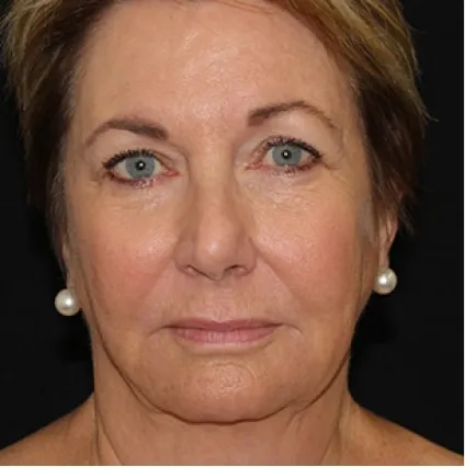Face Skin Tightening Facial Treatments at OrangeTwist