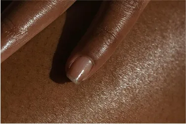 Skin Tightening Overview Skin Tightening