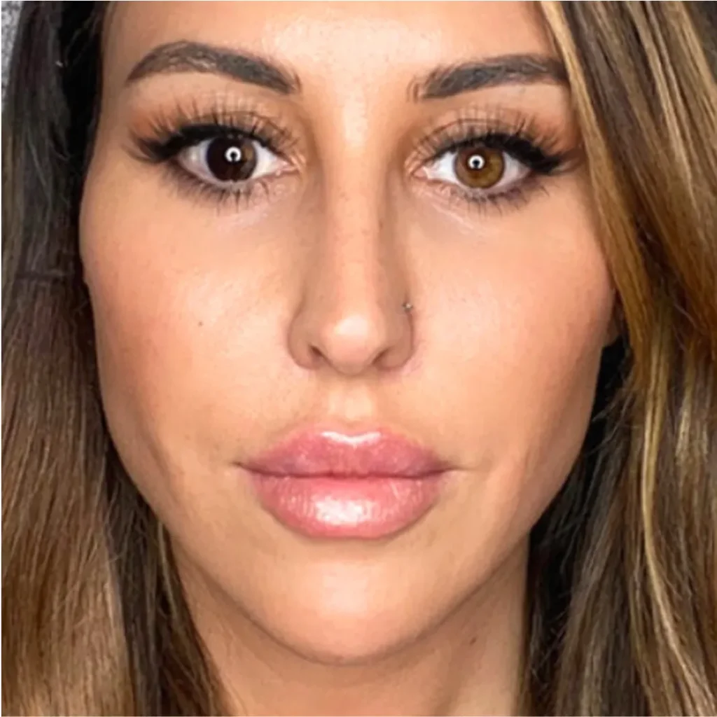 Before and After Botox and Fillers | OrangeTwist Anti-Aging Treatments