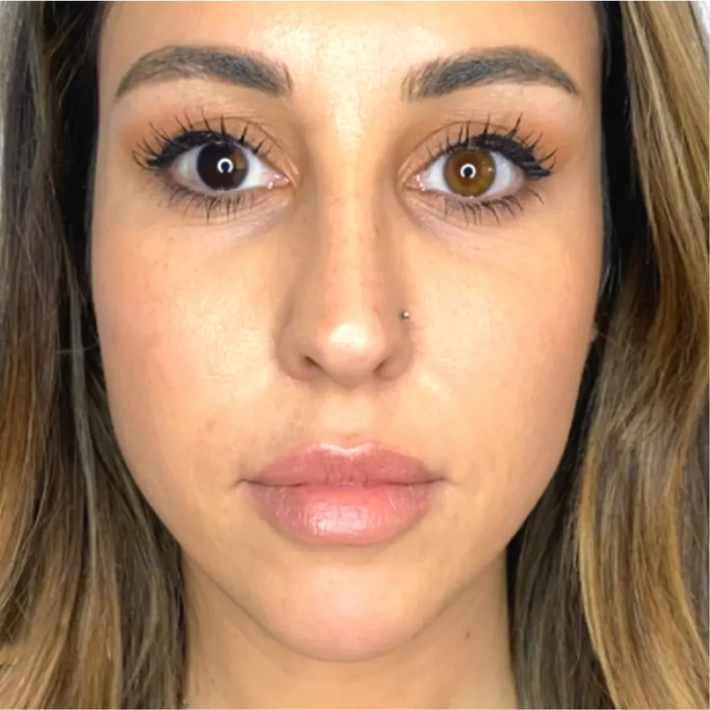 Before and After Botox and Fillers | OrangeTwist Anti-Aging Treatments