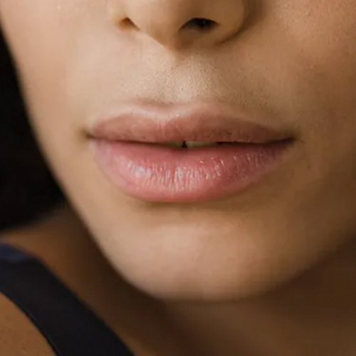 Treatments treatment Fillers Your LA Treatment Shop