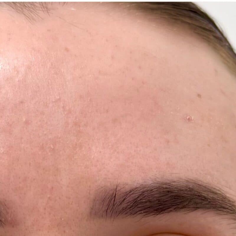 Perfect Derma Peel After 1