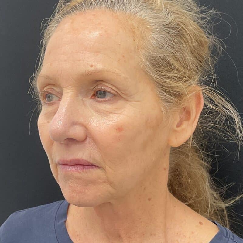 Sculptra-After-2