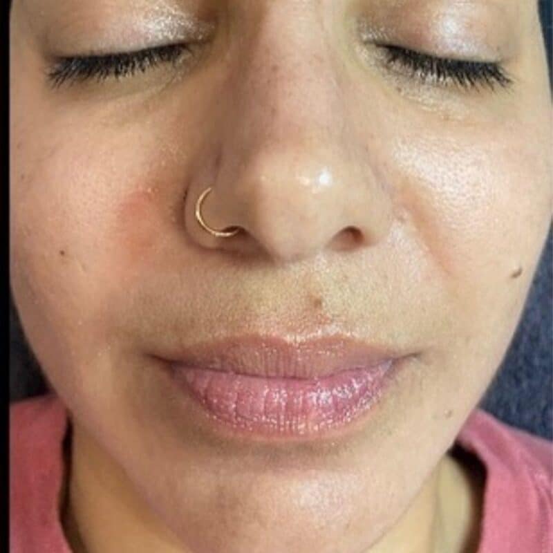 Perfect Derma Peel After 2