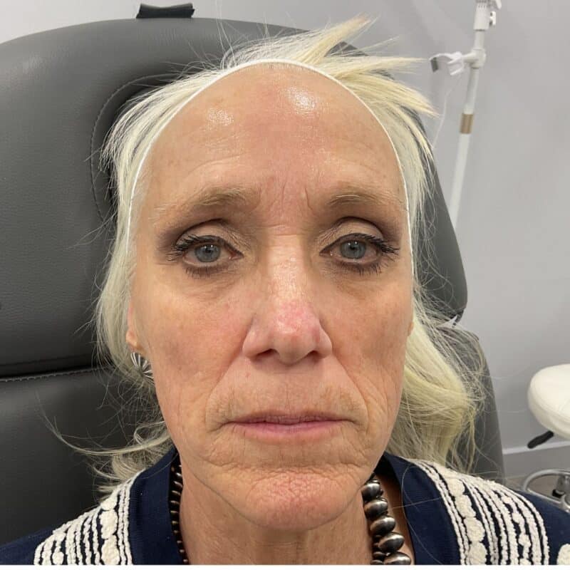 PRX-Botox-After