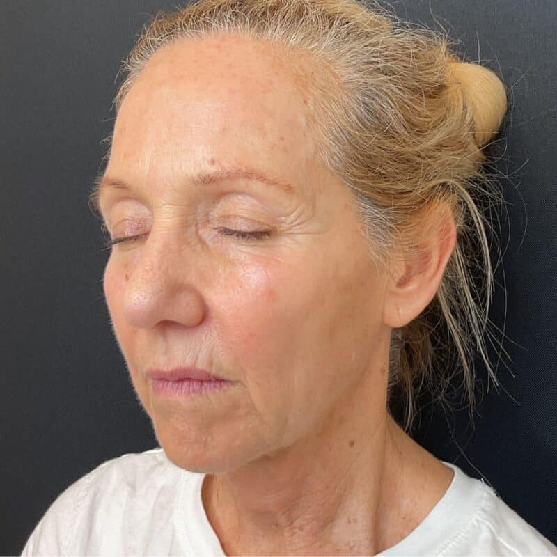Sculptra-Before-2