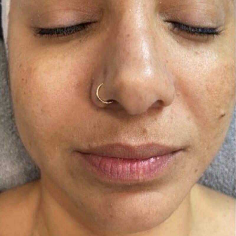 Perfect Derma Peel Before 2