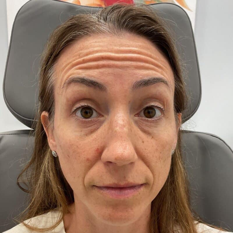 botox-B&A