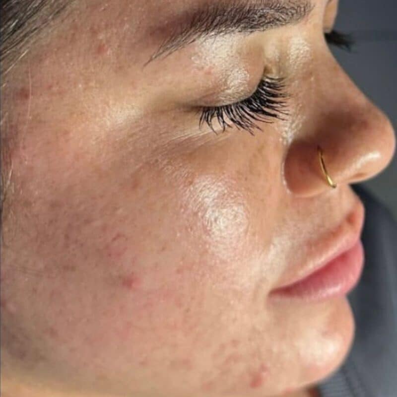 hydrafacial before