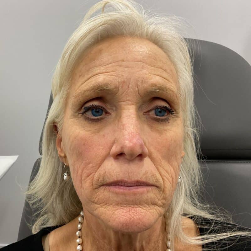 PRX-Botox-Before