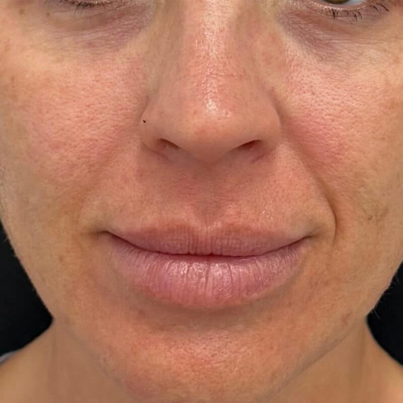 before-zentite