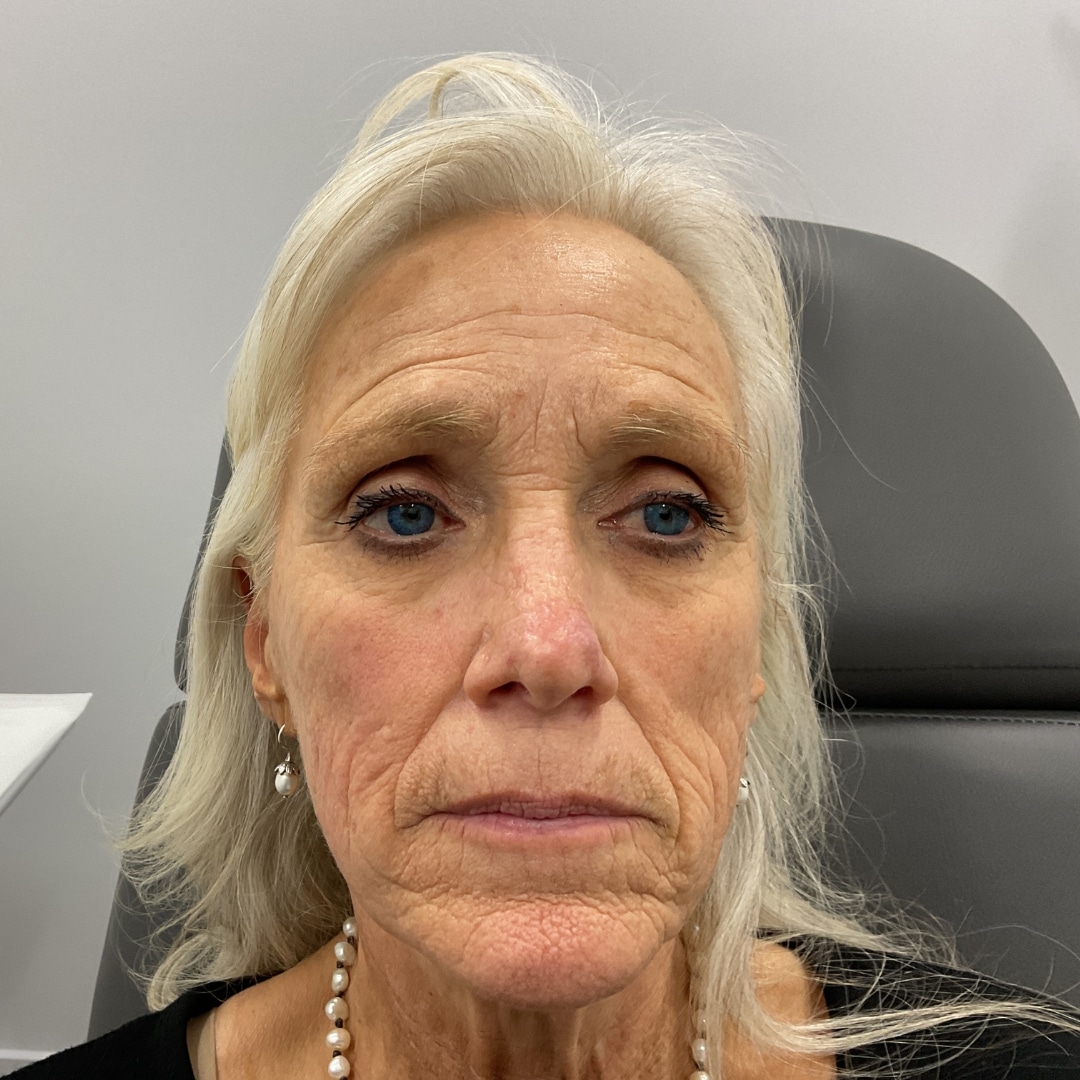 PRX-Botox-before