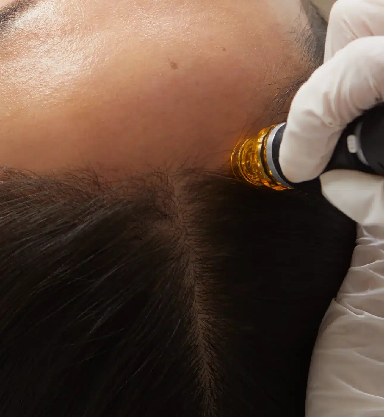 hydrafacial-for-thinning-hair