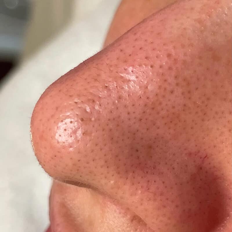 Before-hydrafacial-CloggedPores-nose