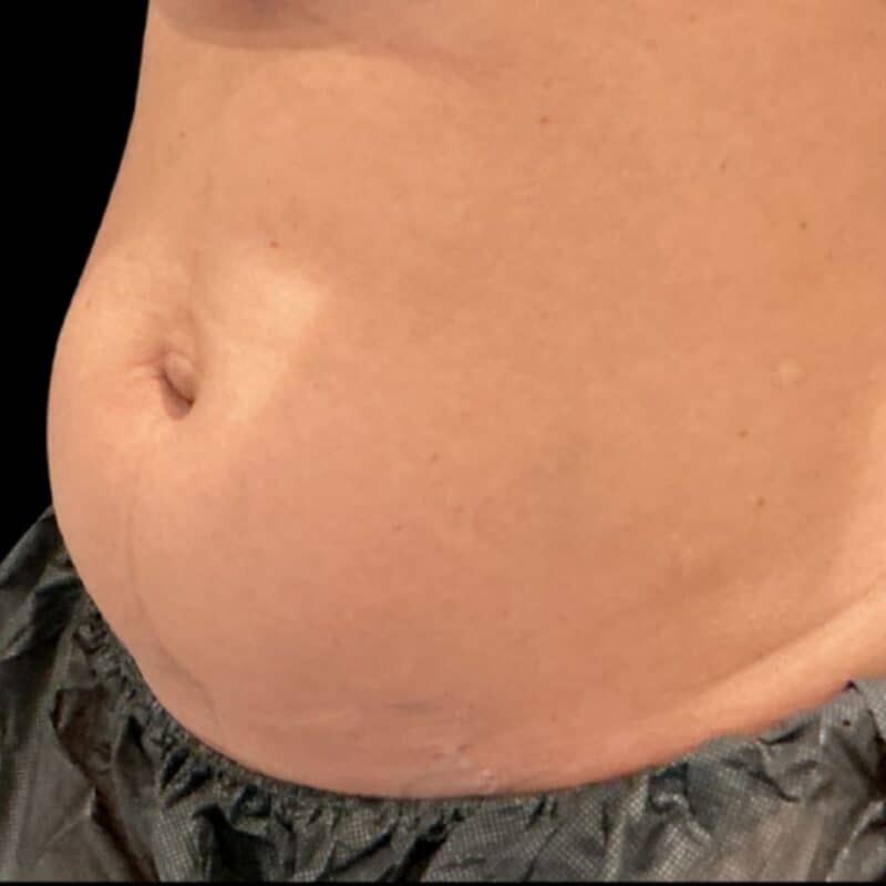 before-coolsculpting-front
