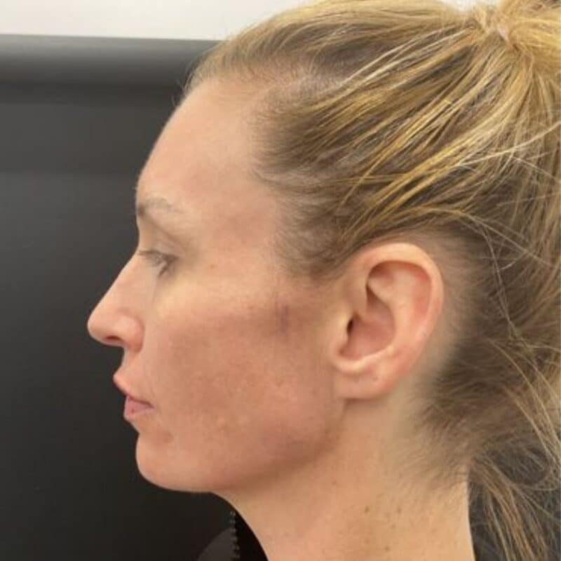 after-full-filler-treatment