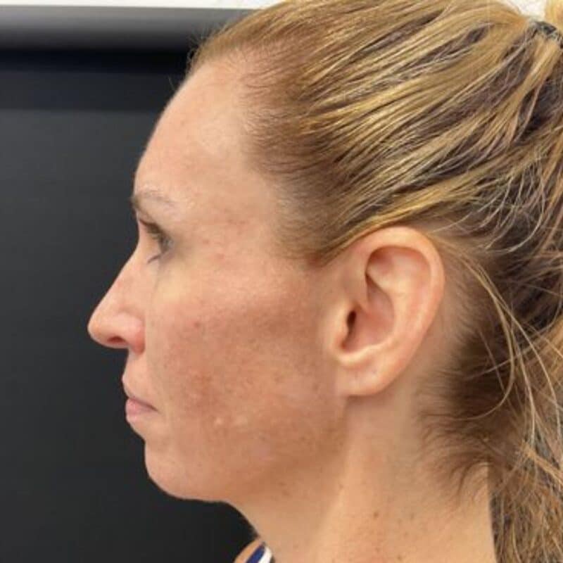 before-full-filler-treatment