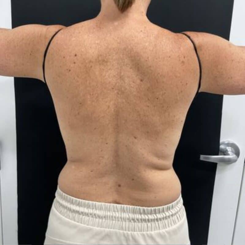 before-coolsculpting-back