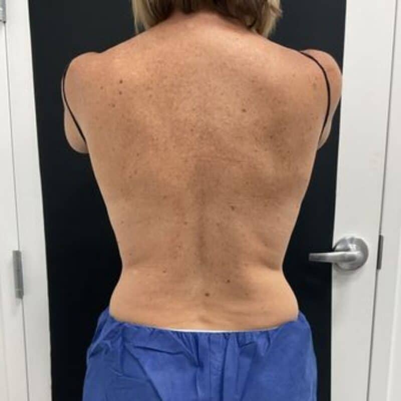after-coolsculpting-back