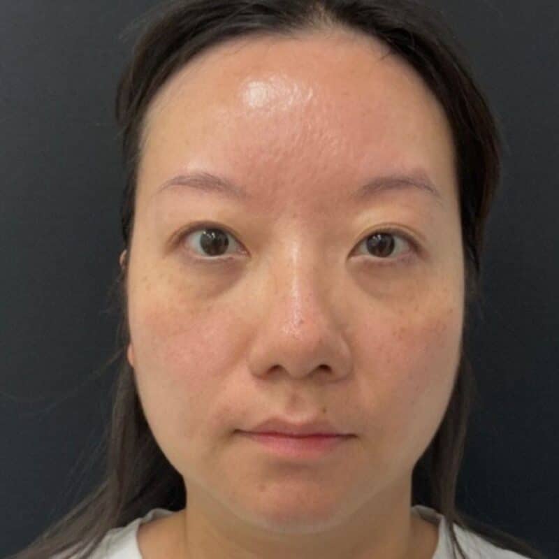 before-hydrafacial-front