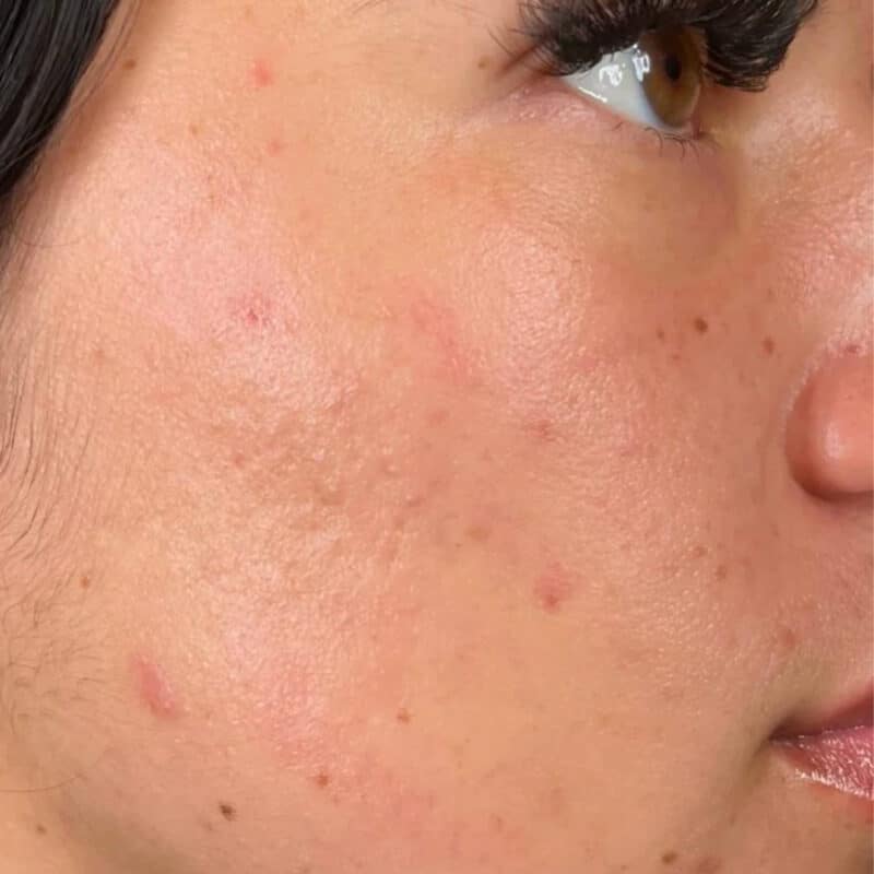 after-acne-cheek