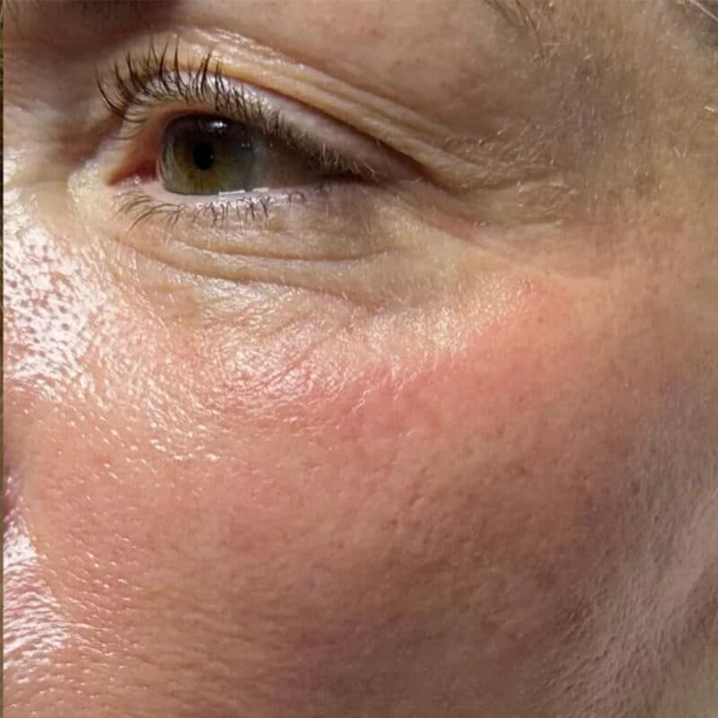 after-hydrafacial-fine-lines-wrinkles