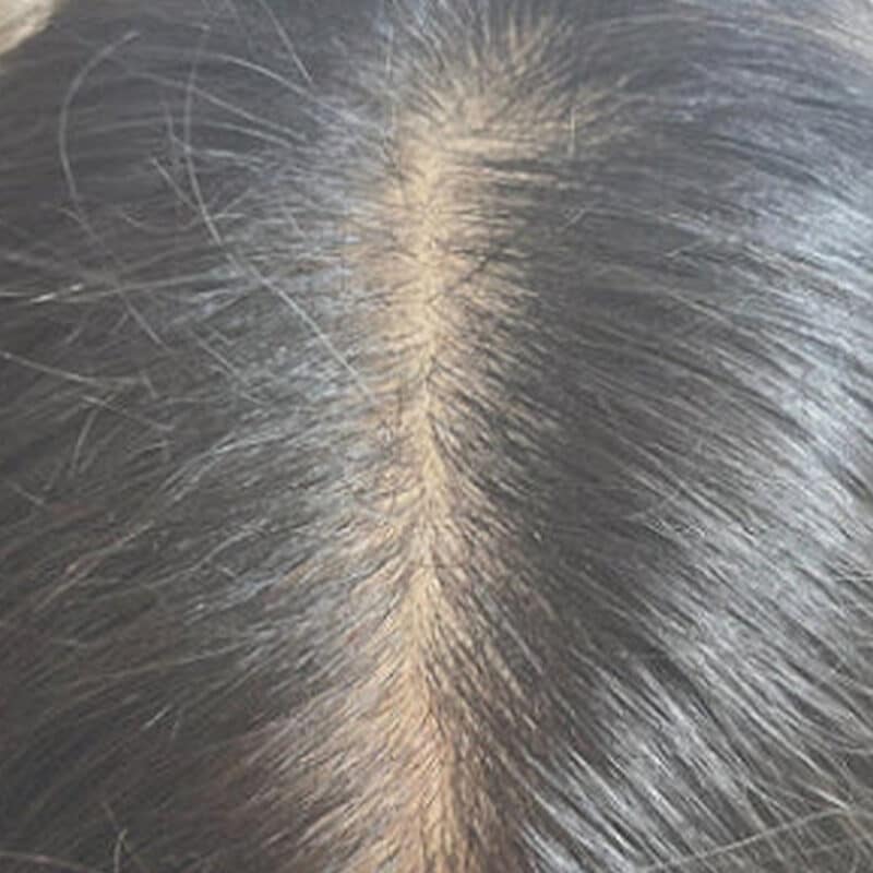 scalp-after-keravive