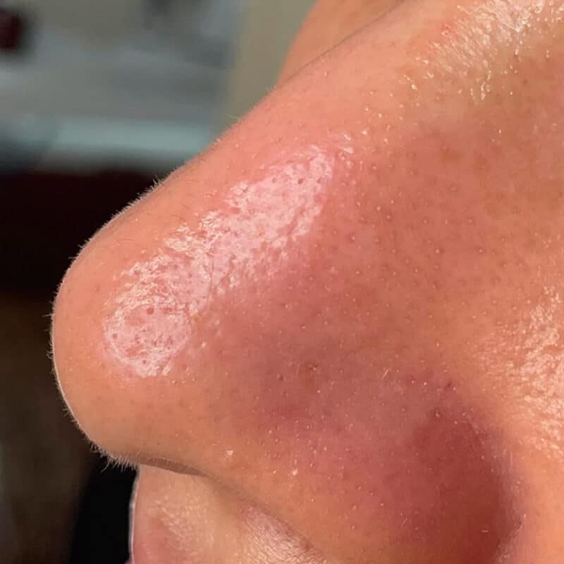 After-hydrafacial-CloggedPores-nose