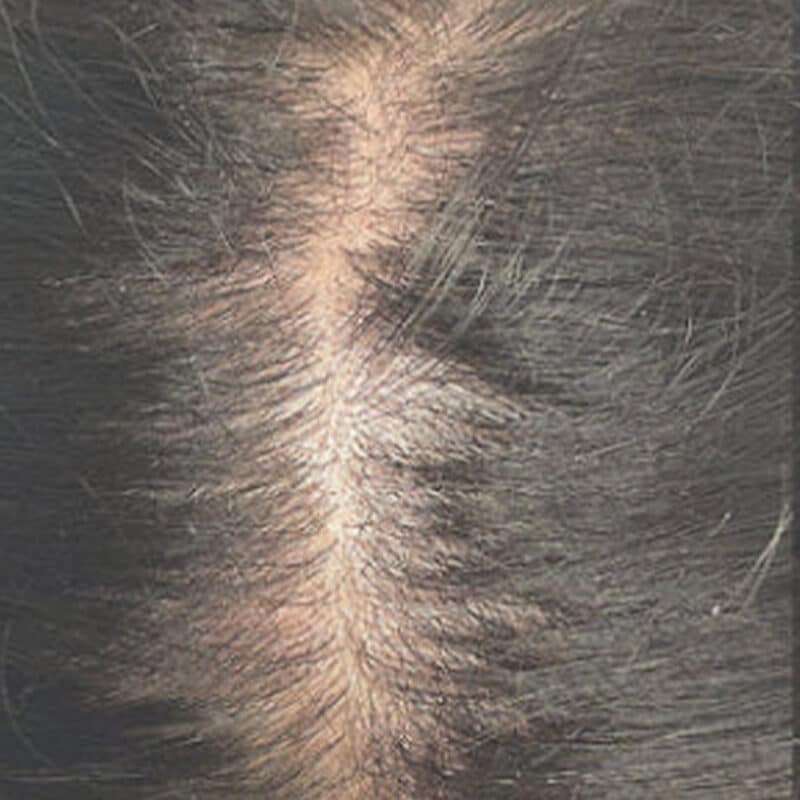 scalp-before-keravive