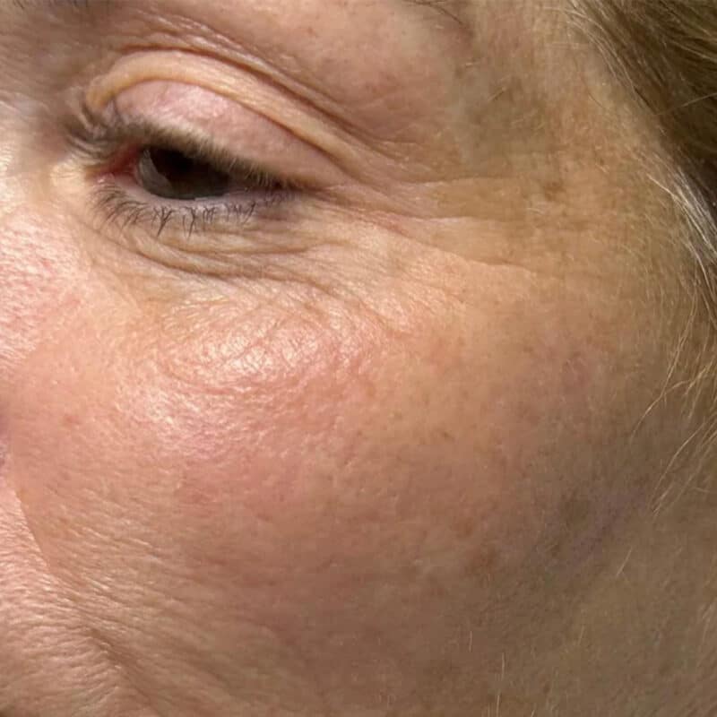 wrinkles-finelines-before-hydrafacial