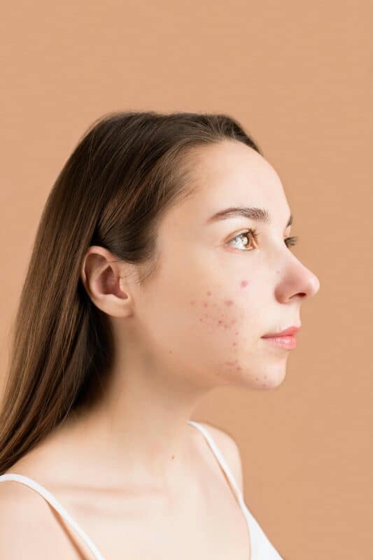 Concerns - Acne treatment
