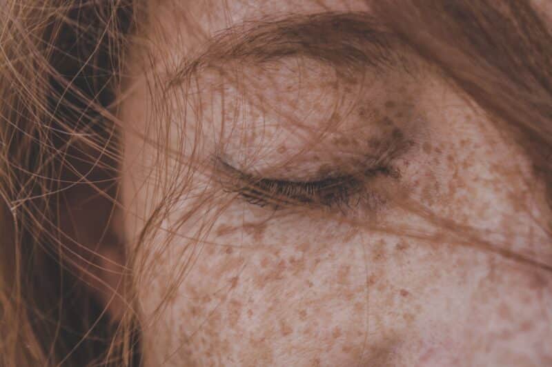 Concerns Melasma