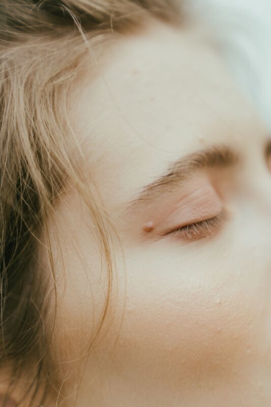 Concerns undereye
